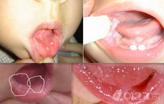 得了鹅口疮怎么办,为什么脚气会影响孩子得鹅口疮