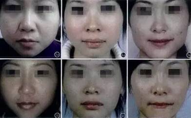 瘦脸针打后悔了怎么做能尽快恢复,瘦脸针人人都可以打吗科普篇