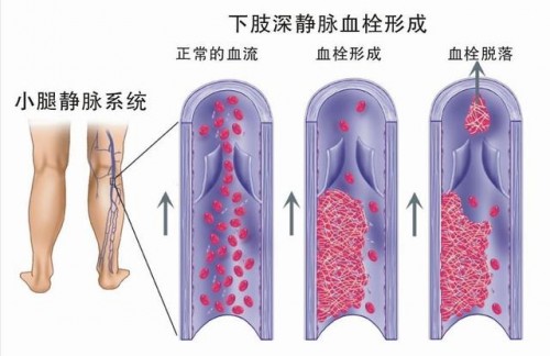 孕期下肢水肿很正常,孕期水肿右腿比左腿严重