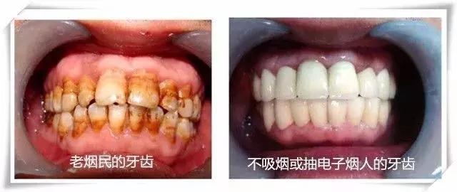 你可能需要的是替烟而不是戒烟（*子烟电**篇）