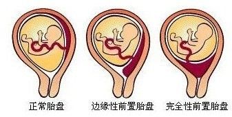 做完子宫肌瘤手术后千万别急着怀孕，小心子宫爆炸！