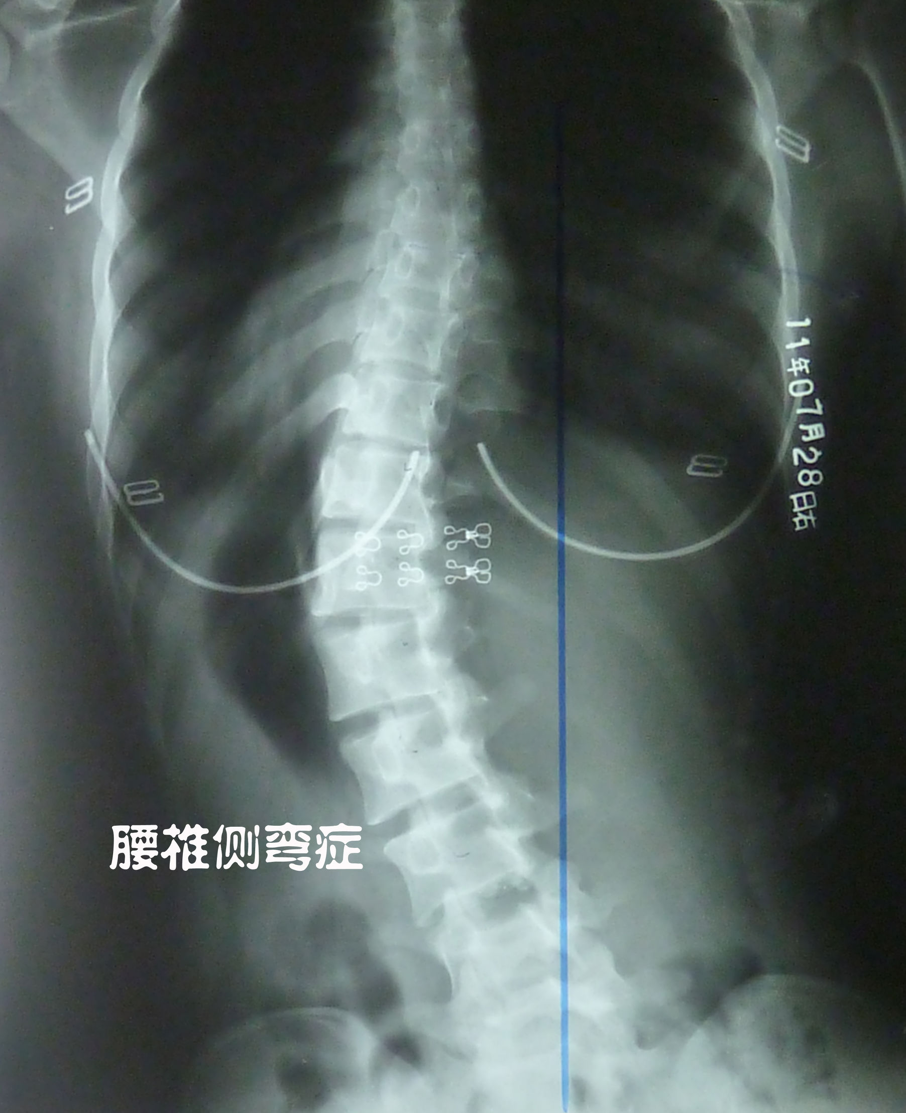 脊椎微讲堂｜腰椎间盘突出：究竟能否治愈？如何治？