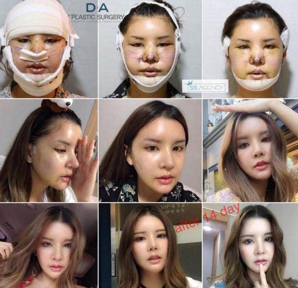 泰国丑女花费700万,泰国丑女整容