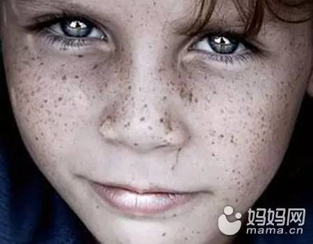 六岁女童脸上长黑斑怎么办,六岁女孩雀斑