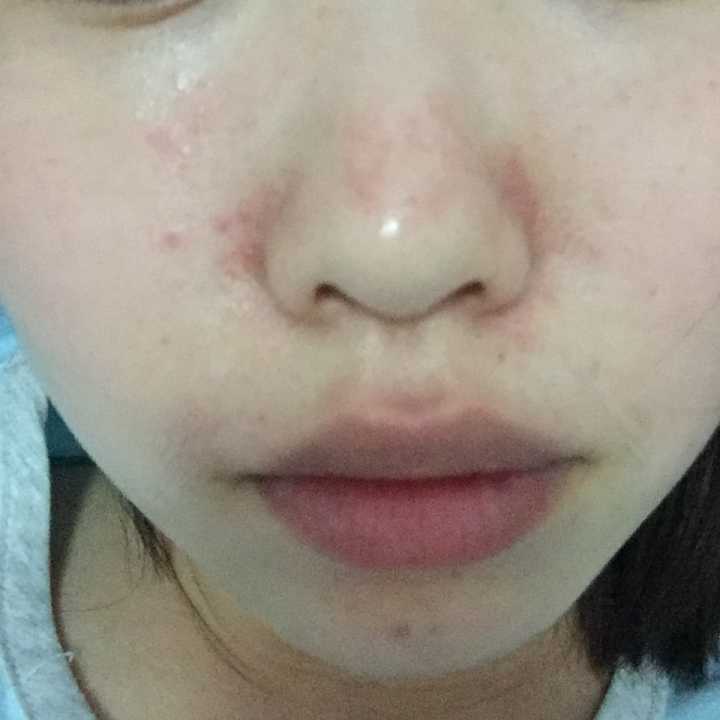 鼻子两侧有红血怎么回事,鼻子两侧有血丝起皮屑