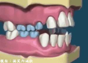 7岁儿童龅牙怎样矫正,龅牙怎么长出来的