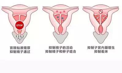 摘节育环会影响备孕吗,摘掉节育环多久可以怀孕