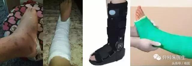 踝关节扭伤后保守穿护踝有用吗,踝关节扭伤韧带撕裂保守治疗