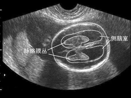 b超显示胎儿脑积水0.4,胎儿左侧脑室宽度9.2毫米是畸形吗