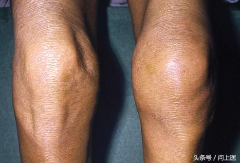 老年人膝盖疼痛的原因和解决方法,上楼梯膝盖疼痛的原因和解决方法