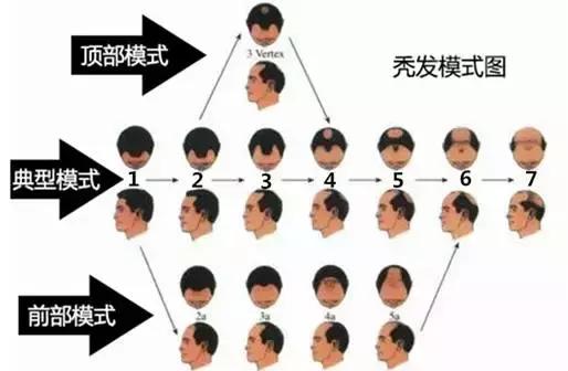 教你一招告别脱发掉发,90后脱发自救的秘方