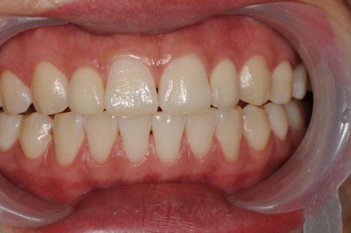 明星做的牙齿贴面,明星做的牙贴面都是什么材质