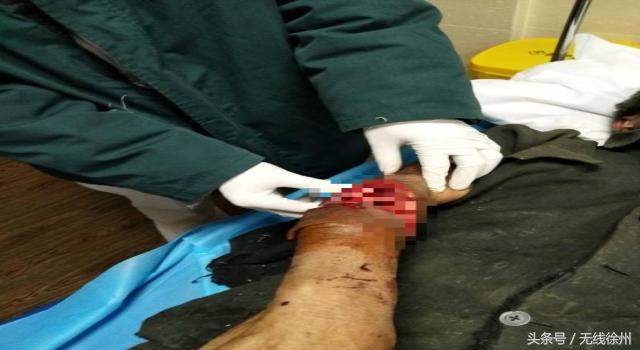 深秋警惕萌宠变“猛”宠，徐州仁慈昨夜连续收治2位被狗咬伤患者