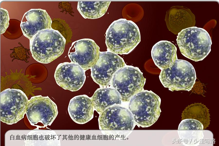 急性淋巴细胞白血病定义,小儿急性淋巴细胞性白血病