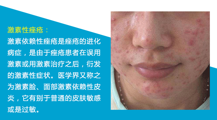 八种痘痘,九大部位的痘痘