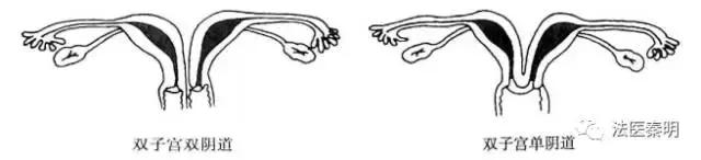 女人有两个子宫怎么办呢,来大姨妈可以同宫吗