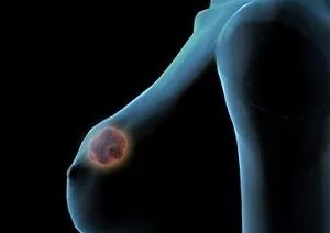 宫颈癌乳腺癌免费筛查怎么检查,妇科肿瘤科普小视频