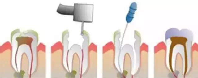 补牙怎么补性价比最高,省口腔医院补牙价格表