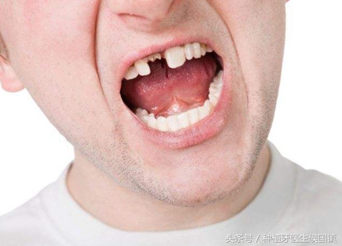 无缘无故掉了一颗牙齿有什么预兆,50岁牙齿掉了一颗是补牙还是植牙