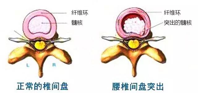 腰椎间盘突出症讲究长期缓解，无任何方法可保证不复发！