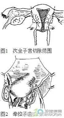 子宫次全切会得宫颈癌吗,筋膜外全子宫切除术具体步骤