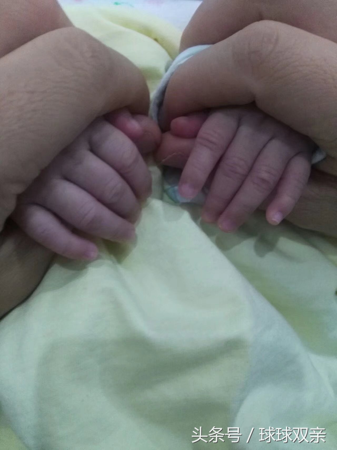 10.3日球球娘亲顺转剖经历分享