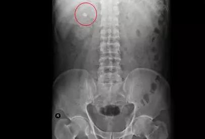 十种解决泌尿结石的方法,泌尿结石怎么缓解疼痛