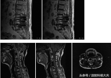 想做脑部核磁但有固定假牙怎么办,做核磁需要把金属假牙拔掉吗