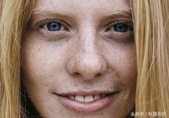 长雀斑是什么原因引起的怎么预防,雀斑是怎么形成的怎样淡化雀斑