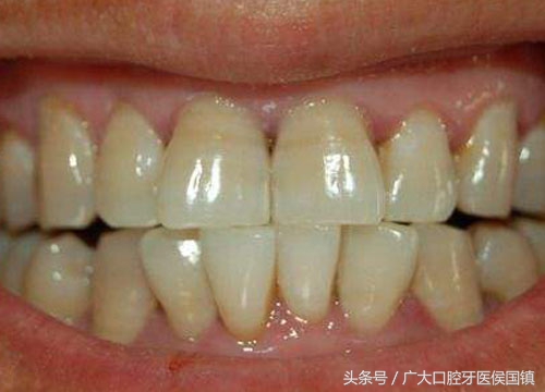 四环素牙齿可以根治吗,四环素牙齿怎么修复最好