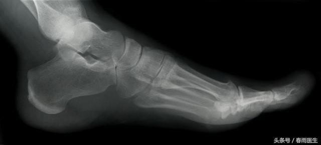 奚梦瑶维密秀摔倒是哪一年,奚梦瑶摔倒对维密秀的影响