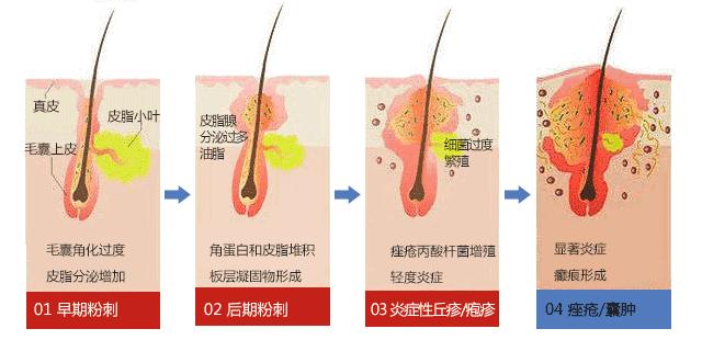 脸上闭口粉刺痘痘毛孔粗大怎么办,脸上长好多闭口粉刺还能敷面膜吗