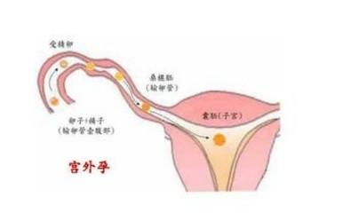 宫外孕用早孕试纸能测出吗,宫外孕使用早孕试纸能测出来吗