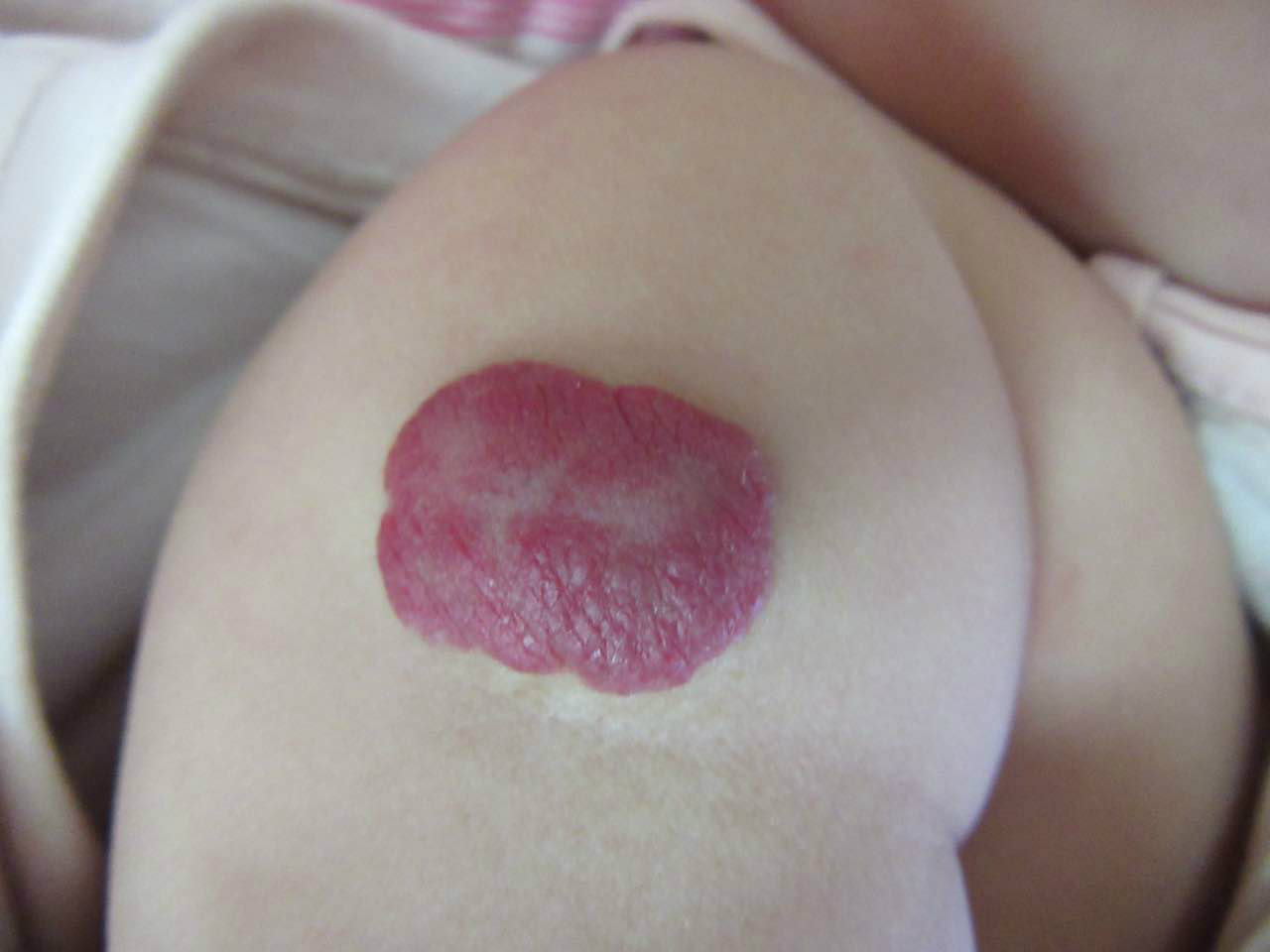 什么外用药物对海绵状血管瘤有效,新生儿血管瘤外用什么药可以治疗