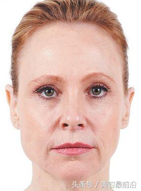 法令纹消除神器有用吗,法令纹黑印子怎么消除