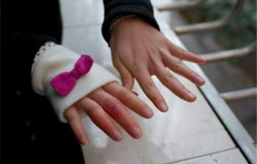 冻伤疮什么意思,手冻伤起疮最有效的方法