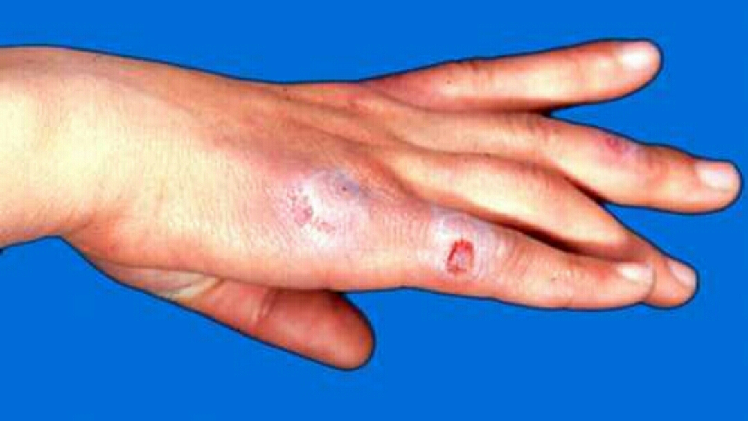 冻伤疮什么意思,手冻伤起疮最有效的方法