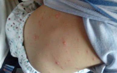 幼儿急疹的疹子出来后怎么护理,宝宝疹子的最佳治疗方法