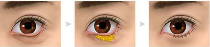 学会这几个动作改善眼部问题,学会这三招女人眼袋再重也能治好