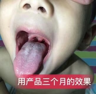 你的扁桃体有什么问题吗,你的扁桃体发炎了么