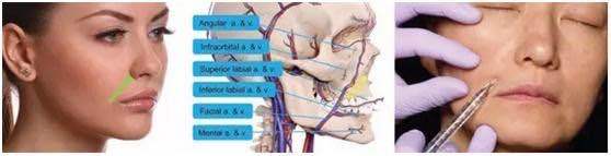 怎么去除法令纹最有效的方法医美,去皱纹最好的方法去法令纹