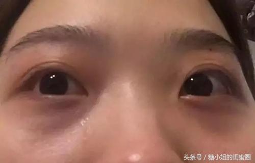 如何拯救黑眼圈眼袋,怎么拯救眼袋和泪沟