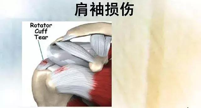 手脚冰凉后背肩疼是什么病,肩疼怕风怕冷是什么病