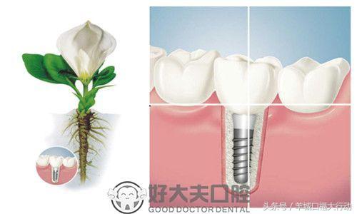 种门牙要缺牙多久,种一颗牙要管多久