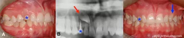 人为什么会少长牙,为什么会有虎牙齿