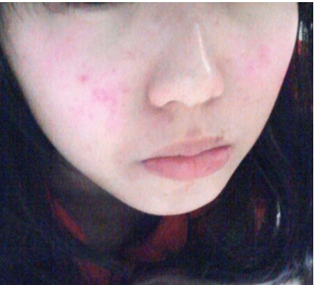 皮肤过敏不吃过敏药可以自己好吗,以前皮肤不过敏现在过敏怎么回事