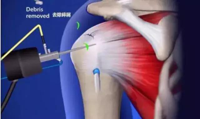 手脚冰凉后背肩疼是什么病,肩疼怕风怕冷是什么病