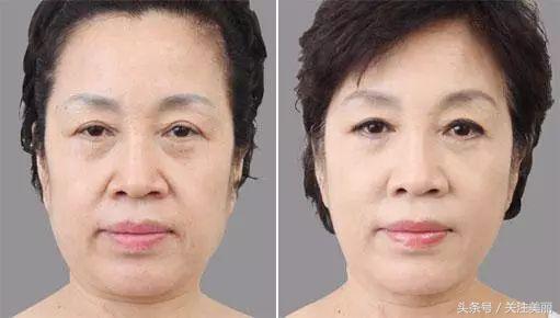 打完除皱瘦脸针多久能洗脸敷面膜,打完瘦脸针多久可以躺下睡觉