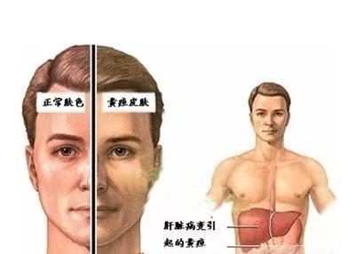 男子网购药服后23天死亡,23岁小伙腰疼自己吃中药