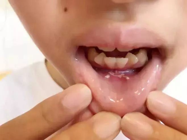 甲状腺术后没有引流管,甲状腺术后伤口不愈合是什么原因